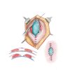 Mallas ovales planas, de monofilamento de Polipropileno no absorbible  <br><b>Oval Patch</b></br> - Imagen 2